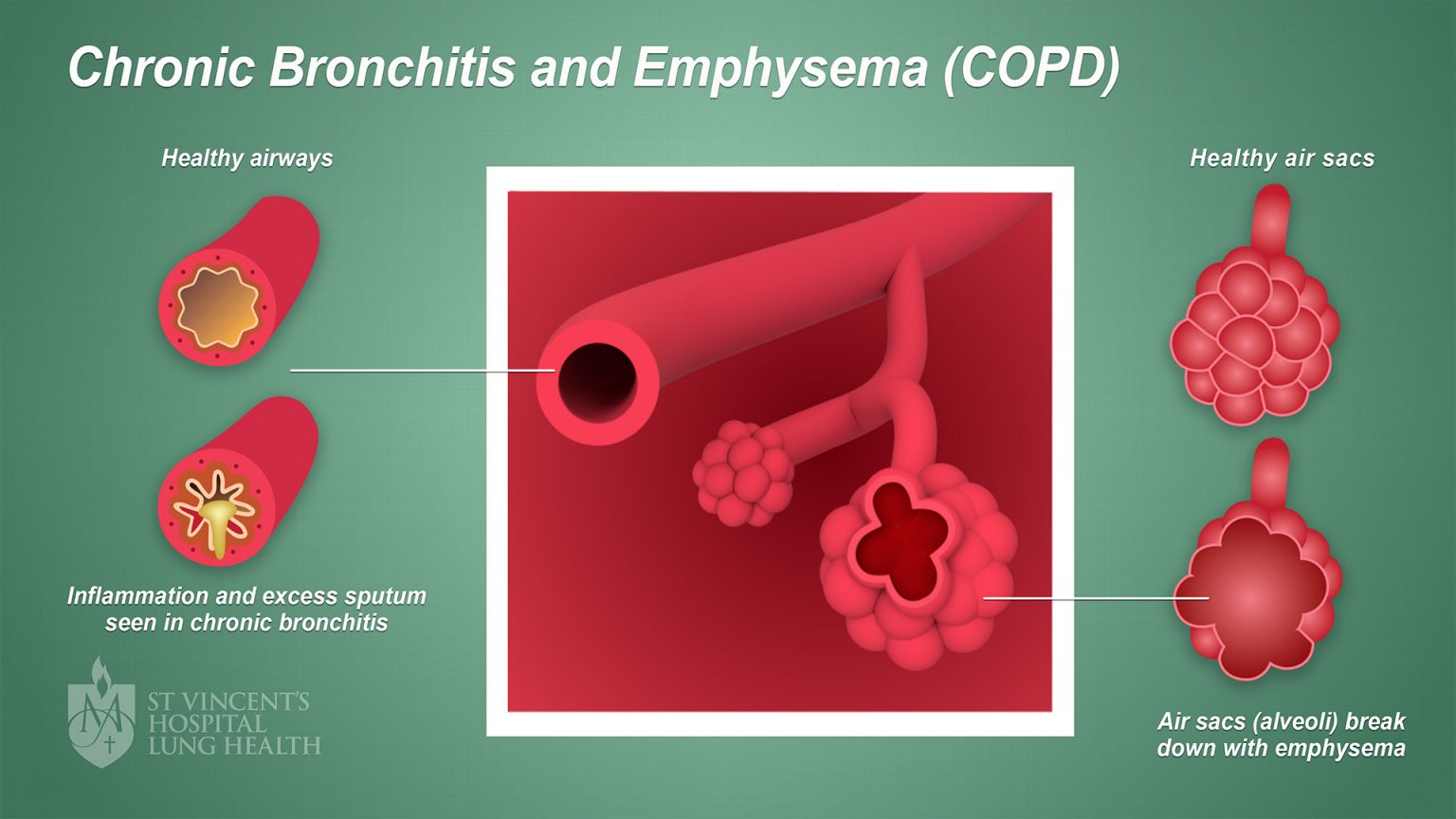 Your Lungs Matter; What You Need To Know About COPD - Varnam Malaysia